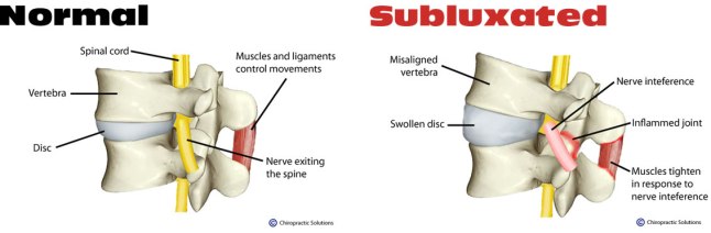 subluxation